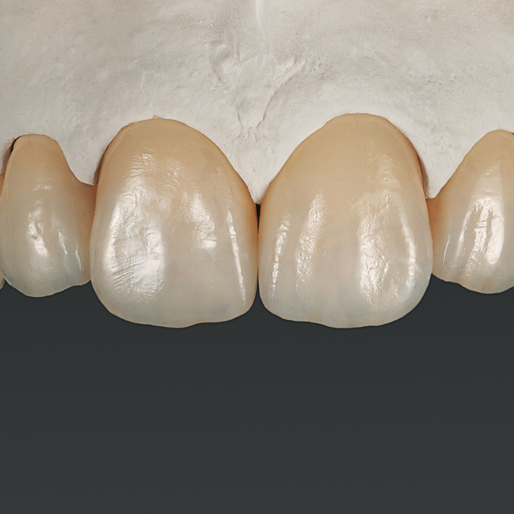 Ful-Kontur Zirkonya Kronlar (Ağız-içi Tarama İle)